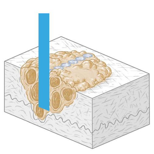 蒸散治療イメージイラスト