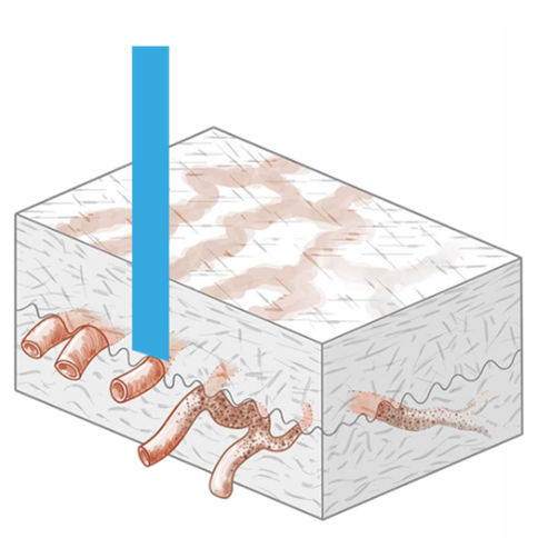 凝固治療イメージイラスト