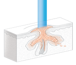 薄い皮膚層の除去イメージイラスト