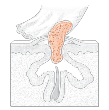 膿を出すイメージイラスト